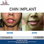 Chin Implant Surgery India Low Cost Benefits - Dr. Kashyap Clinic Delhi