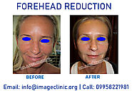 Contact Us Best Forehead Reduction Surgery in Aya Nagar, New Delhi