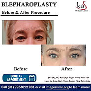 Blepharoplasty Cosmetic Surgery by Dr Kashyap in Delhi India