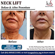 Best Neck Lift Surgery by Dr. Ajaya Kashyap Plastic Surgeon in Delhi, India
