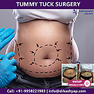 Best Tummy Tuck Surgeon in Delhi, Abdominoplasty Cost in Delhi