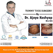 Abdominoplasty or Tummy Tuck Surgery at Best Cost in Delhi