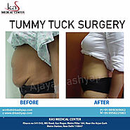 KAS MEDICAL CENTER : Tummy Tuck Abdominoplasty Surgery Clinic in Delhi