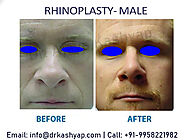 Nose Reshaping Surgery Delhi Low Cost Benefits - Dr. Kashyap Clinic Delhi