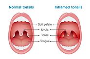 Treatment of Tonsillitis - Philadelphia Holistic Clinic - Dr. Tsan & Associates