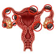 Treatment for Endometriosis - Philadelphia Holistic Clinic - Dr. Tsan & Co