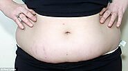 Best Tummy Tuck with Stretch Marks Removal Surgery in Delhi