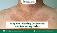 Why I Am Getting Discolored Patches on My Skin?