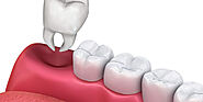 Wisdom Tooth Extractions in Scarborough