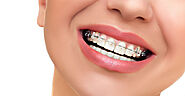 Common Misconceptions About Orthodontic Treatments