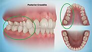 What is a Crossbite and How to Fix it? | by Emily Clark | Apr, 2021 | Medium