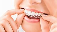 What Is The Process Of Receiving Invisalign Treatment?