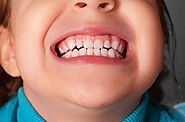 Tips To Care For Braces And Maintain Oral Hygiene