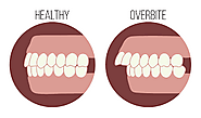What Are The Problems Caused By An Overbite? - Bloggers Adda