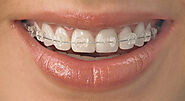 Radiance™ Clear Braces - Innisfil Orthodontics | Innisfil ON