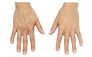 Hand Rejuvenation Toronto - Therapeutic Aesthetics