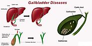 Types of Gallbladder Diseases: drvikassingla — LiveJournal