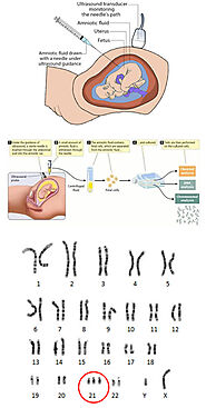 அம்னோசென்டெசிஸ் | Amniocentesis Procedure