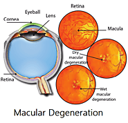 Age-Related Macular Degeneration and Low Vision Awareness Month