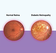 Ultimate Guide on Treatment and Prevention of Diabetic Retinopathy