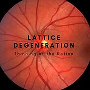 How Eyes Will Be Affected If You Have Lattice Degeneration?