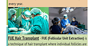 Best Hair Transplant in Chandigarh