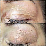 All You Need To Know About Non Surgical Eye Lift