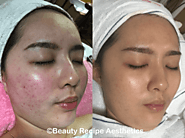 Acne Facial For Glowing And Radiant Skin