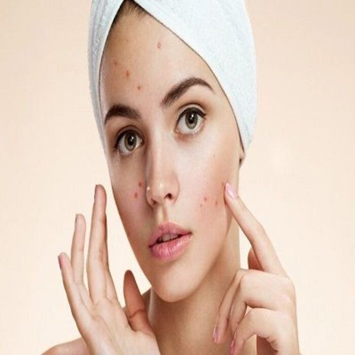 Pimples Treatment In Islamabad A Listly List 