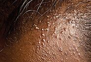 Scalp Folliculitis –What It Is & What You Can Do About It? – Nina Ross Hair Therapy