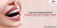 What are the Long Term Health Benefits Of Braces?