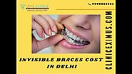 Invisible Braces Cost in Delhi