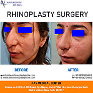 Are You Looking for Best Rhinoplasty Surgeon in Delhi