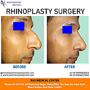 KAS MEDICAL CENTER : Rhinoplasty Nose Surgery Clinic in Delhi India