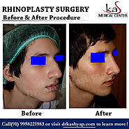 Nose Reshaping Surgery - Dr. Ajaya Kashyap Triple American Board Certified surgeon