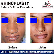 Contact Best Nose Reshaping Surgery Specialist Book Your Appointment Today