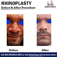 Contact Best Nose Surgeon in Delhi Book Your Appointment Today