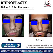 Looking for Best Nose Surgery in Delhi, India at Affordable Cost?