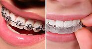 Warning Signs That You Need Dental Braces
