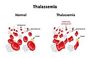 Tan máu bẩm sinh (Thalassemia) là gì? Hiểu đúng để phòng tránh