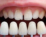 Dental Implants - Beginning of a New Era in Cosmetics Dentistry