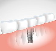 Faqs About Dental Implants