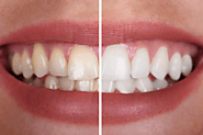 Common Types Of Cosmetic Dental Procedures