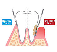 Eliminate problem With Gum Disease Treatment In Melbourne