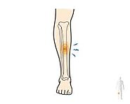 Know The Best Treatment For Stress Fracture of the Tibia