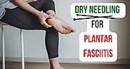 Dry needling for plantar fasciitis : Cost, Procedure and Side Effects |