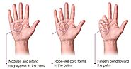 What You Need to Know about Dupuytren’s Contracture