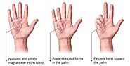 Go for a Non-Surgical Treatment for Dupuytren’s Contracture