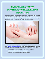 Incredible Tips to Stop Dupuytren’s Contracture from Progressing