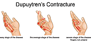 Non-Surgical and Surgical Treatments Available for Dupuytren’s Contracture